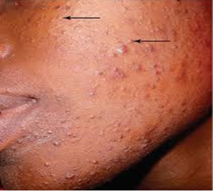 Teenage Health and Wellbeing: Acne